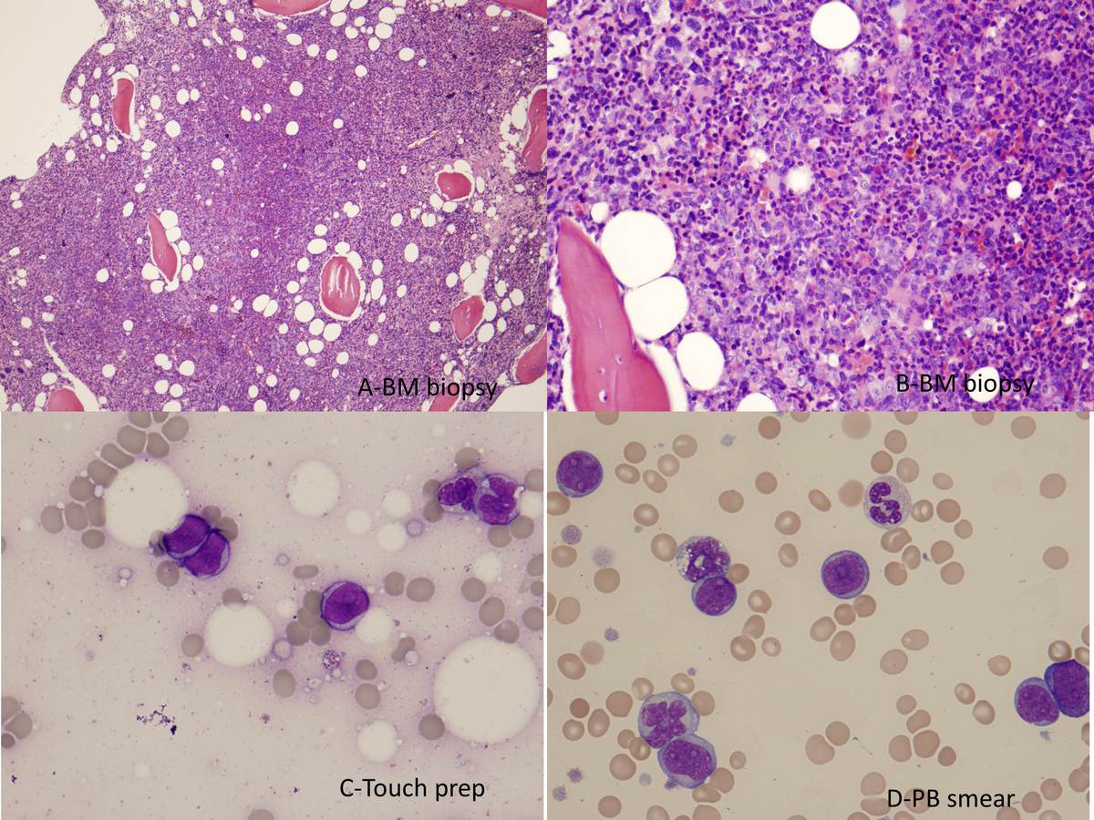 A- Hypercellular marrow with increased megakaryocytes that are atypical.  B- Areas of immature cells consistent with blasts.  C- Touch prep (dry tap) showing blasts and occasional monocytes.  D- PB shows increased blasts (>20%).